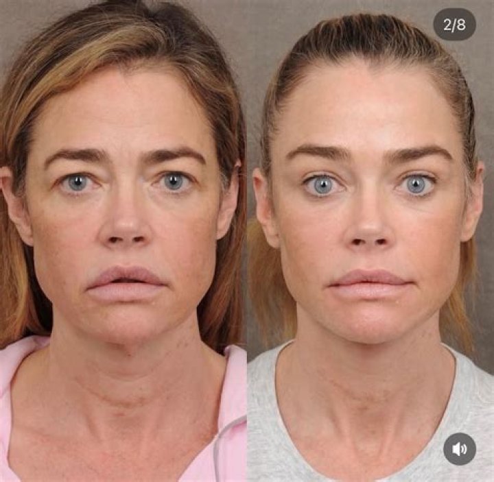 All About RHOBH Kyle Richards Plastic Surgery With Before And After Photos