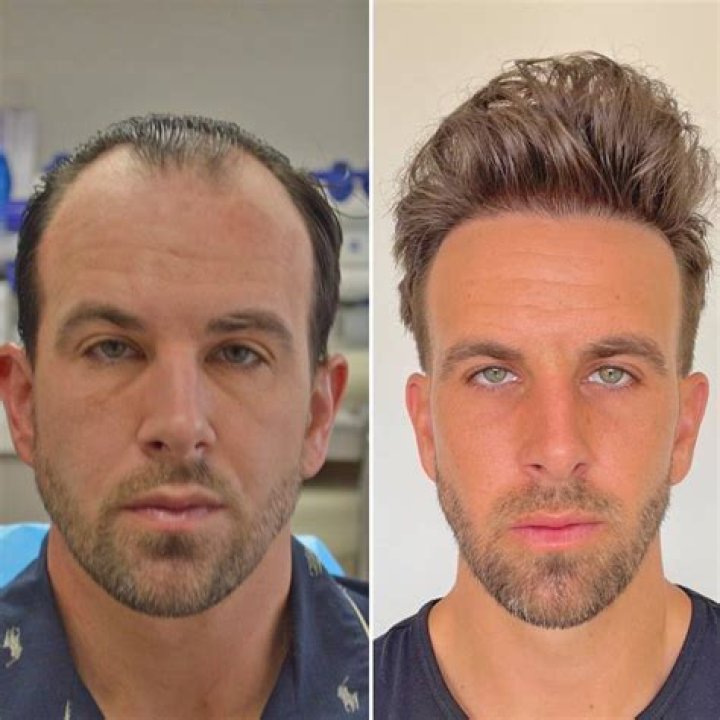 Chris Cuomo Hair Piece and Toupee: Is Chris Bald? Facts on his Hair Replacement and Wig