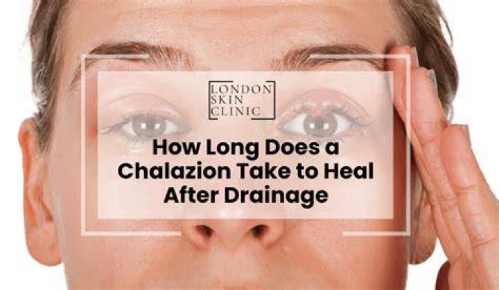 How long does a chalazion take to drain